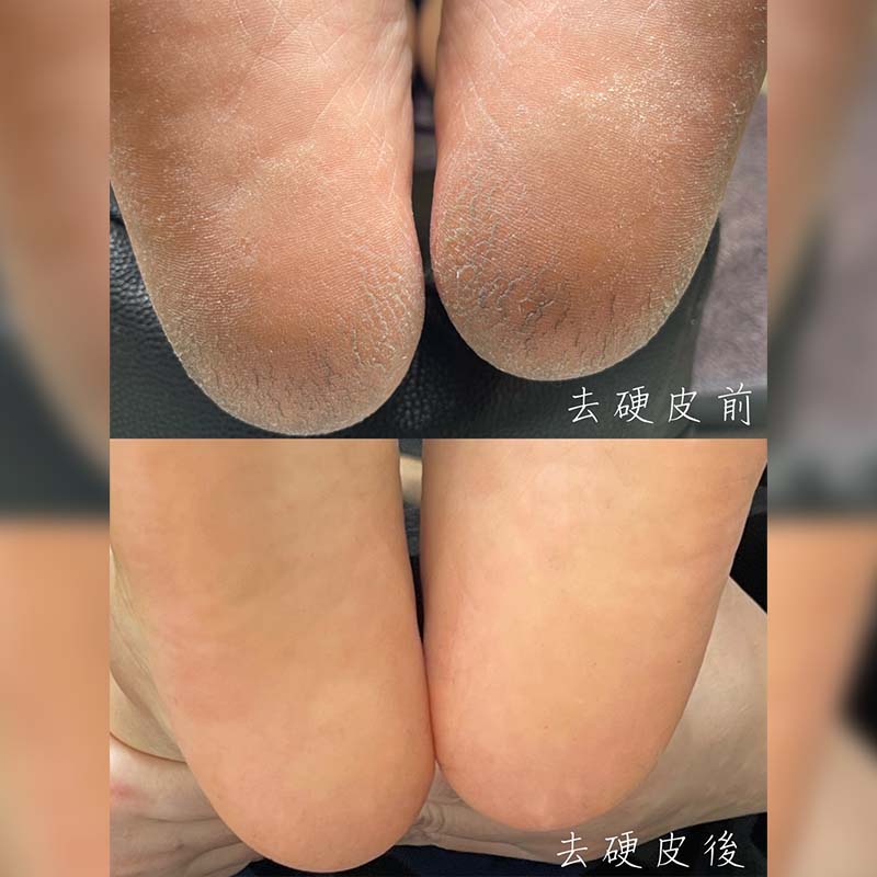 足部保養